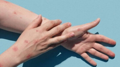 Azərbaycana meymunçiçəyi virusunun müayinəsi üçün testlər və xəstəliyə qarşı lazımi dərman preparatları gətirilib