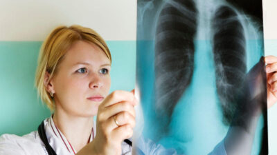 Akciğer kanseri dünya çapında tüm kanser vakalarının yaklaşık %13’ünü ve kanser ölümlerinin beşte birini oluşturmaktadır